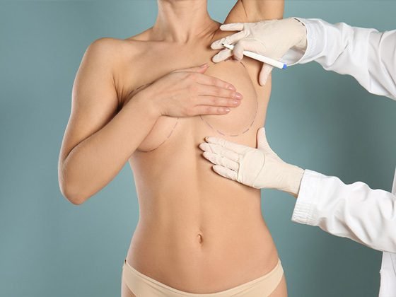 Cirujana marcando zonas en planificación preoperatoria de mamoplastia de aumento