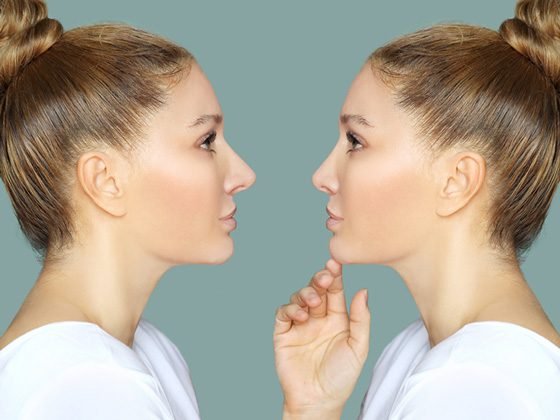 Recuperación de rinoplastia semana a semana