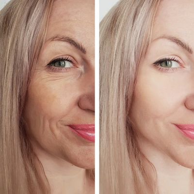 Signos de envejecimiento facial — flacidez, jowls y pérdida de contornos submandibulares