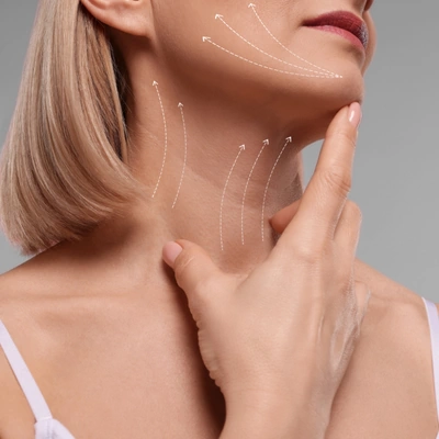 Zonas del minilifting de cara — 2/3 inferiores: jowls, papada y contorno mandibular